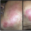 What does a filler infection look like?