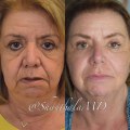 A Comprehensive Look at Laser Treatments for Anti-Aging and Skin Rejuvenation