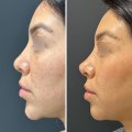 Does filler really dissolve over time?