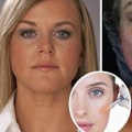 What happens when you stop getting facial fillers?