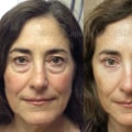 Lower Blepharoplasty: Enhancing Your Appearance with Eyelid Surgery