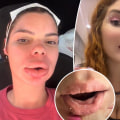 What does an allergic reaction to fillers look like?