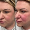 Does cheek filler look swollen at first?