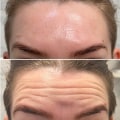 All You Need to Know About Botox Injections