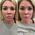 Why do you need less filler over time?
