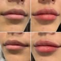 Can lip fillers migrate after 4 days?