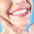 Gummy Smile Solutions: Beyond Traditional Botox