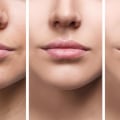 How long does it take for filler to flatten?