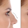Rhinoplasty: Enhance Your Appearance with Cosmetic Surgery