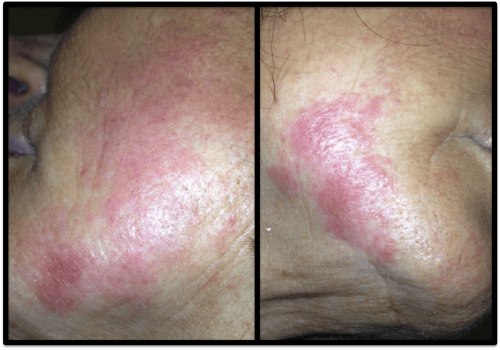 What does a filler infection look like?