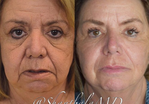 A Comprehensive Look at Laser Treatments for Anti-Aging and Skin Rejuvenation