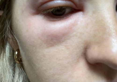 Can you sue a skincare company for an allergic reaction?