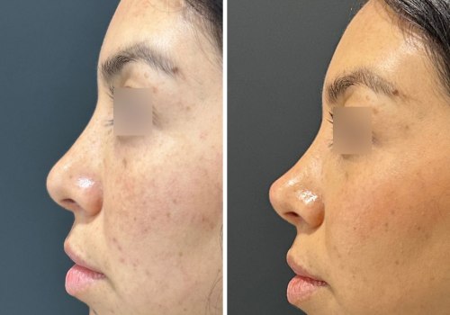 Does filler really dissolve over time?