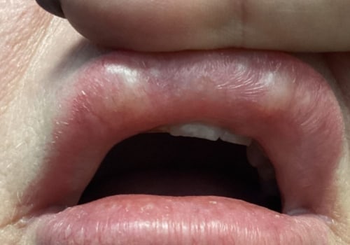 How to get rid of filler lumps?