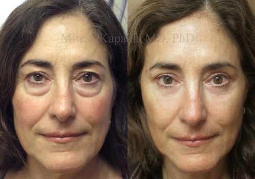 Lower Blepharoplasty: Enhancing Your Appearance with Eyelid Surgery