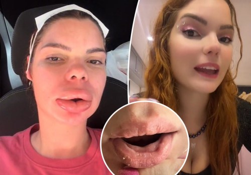 What does an allergic reaction to fillers look like?