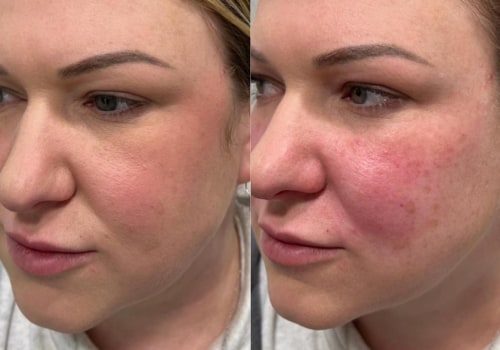 Does cheek filler look swollen at first?