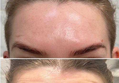 All You Need to Know About Botox Injections
