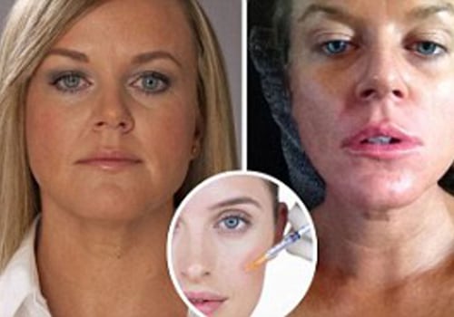 Does filler have long-term effects?