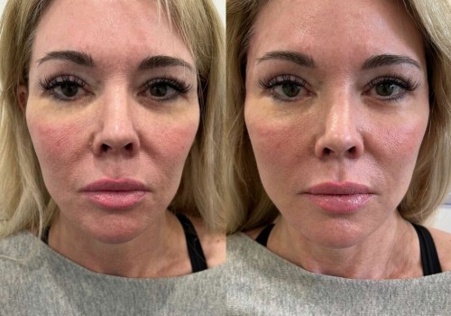 Why do you need less filler over time?