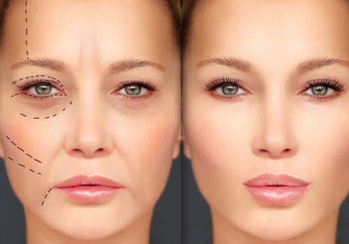 Is 1ml cheek filler noticeable?