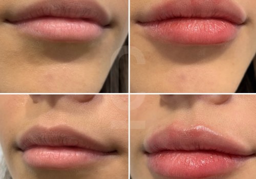 Can lip fillers migrate after 4 days?