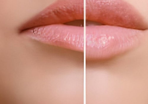Lip Flip Botox: A Subtle Enhancement Explained by a Chiswick Doctor