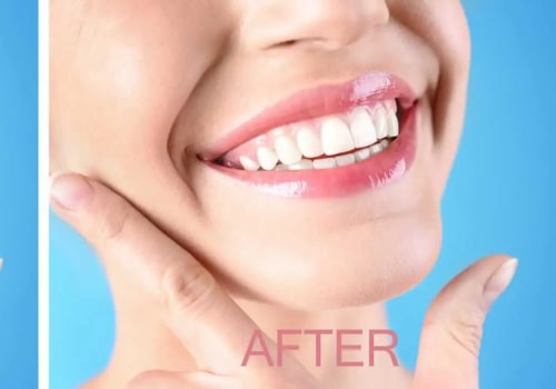 Gummy Smile Solutions: Beyond Traditional Botox