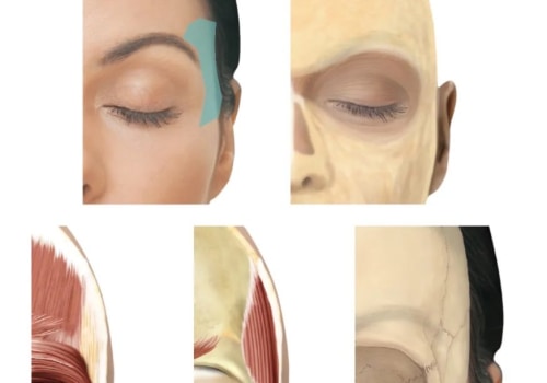 Temple Filler in Chiswick: Restoring Balance Without Surgery