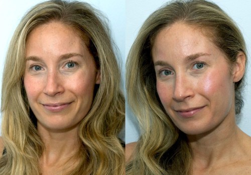 Do fillers get better over time?