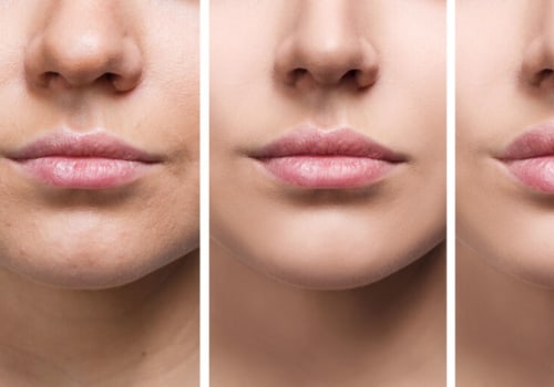 How long does it take for filler to flatten?
