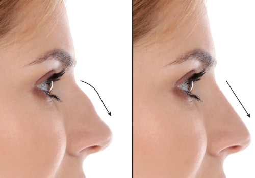 Rhinoplasty: Enhance Your Appearance with Cosmetic Surgery