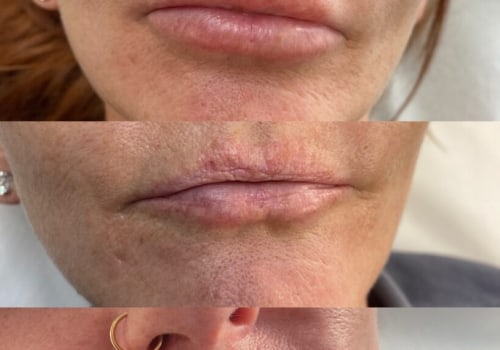 How long does filler stay swollen?